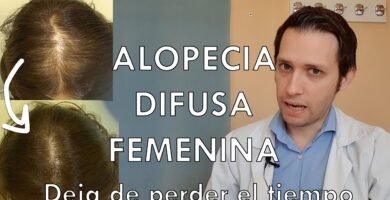 ¿Cómo cuidar mi alopecia?