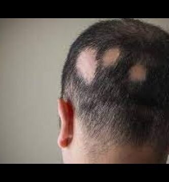 ¿Cómo curar la alopecia por hongos?
