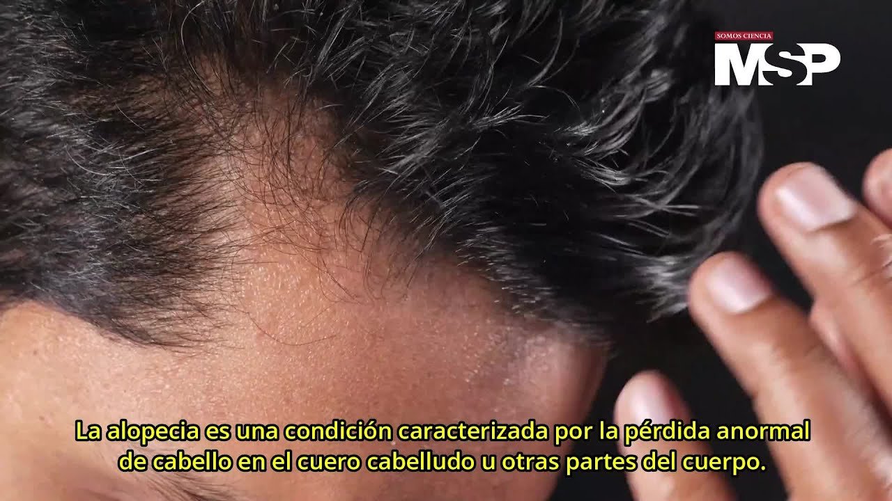 ¿Cómo saber cuál es mi tipo de alopecia?