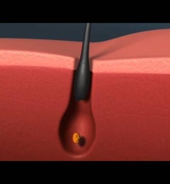 ¿Cuándo se cae el cabello por alopecia vuelve a crecer?