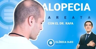 ¿Cuánto tarda en volver a salir el pelo en la alopecia areata?