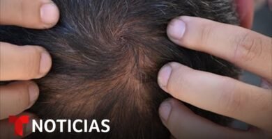 ¿Por que avanza la alopecia?