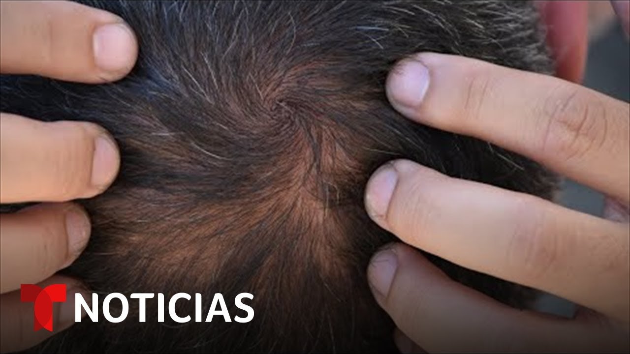 ¿Por que avanza la alopecia?