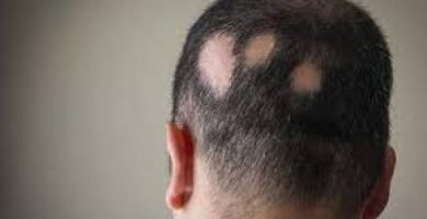 ¿Qué crema es buena para la alopecia areata?