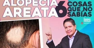 ¿Qué hacer si me está dando alopecia?