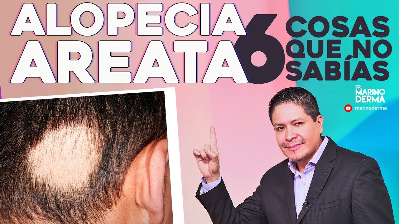 ¿Qué hacer si me está dando alopecia?