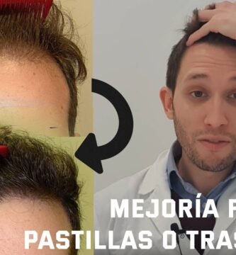 ¿Que mejora la alopecia?