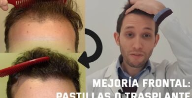 ¿Que mejora la alopecia?