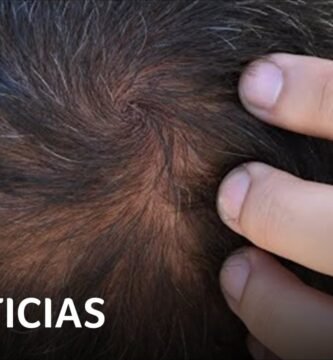 ¿Qué órgano afecta la alopecia?