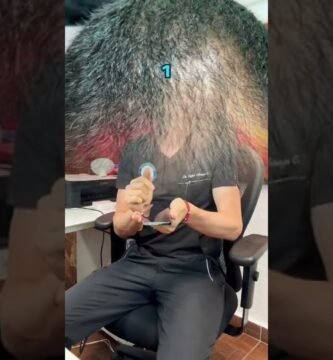 Terapias innovadoras contra la alopecia difusa