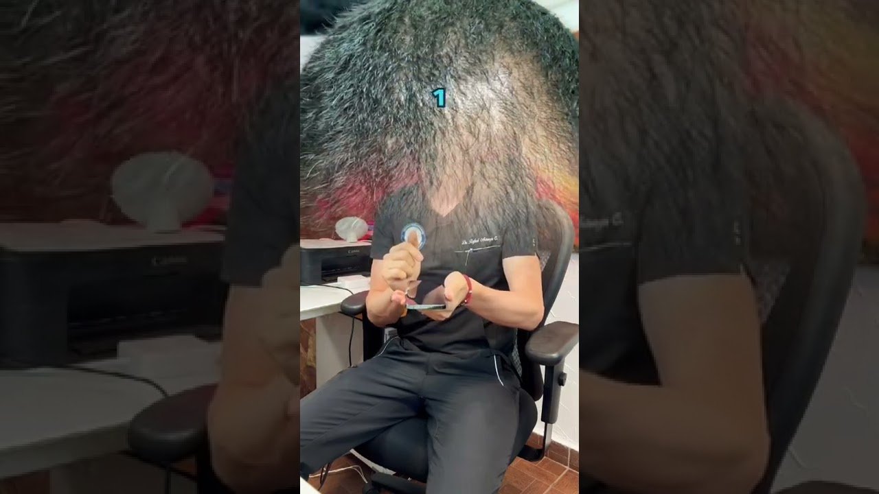 Tratamientos recomendados para la alopecia difusa