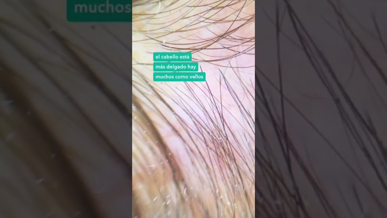 Factores genéticos que causan la alopecia difusa