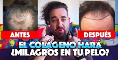 Importancia del colágeno frente a la implantes capilares