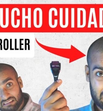 Minoxidil y dermaroller: combinación efectiva