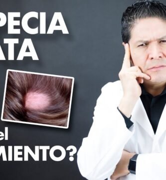 Tratamientos recomendados para la alopecia universal