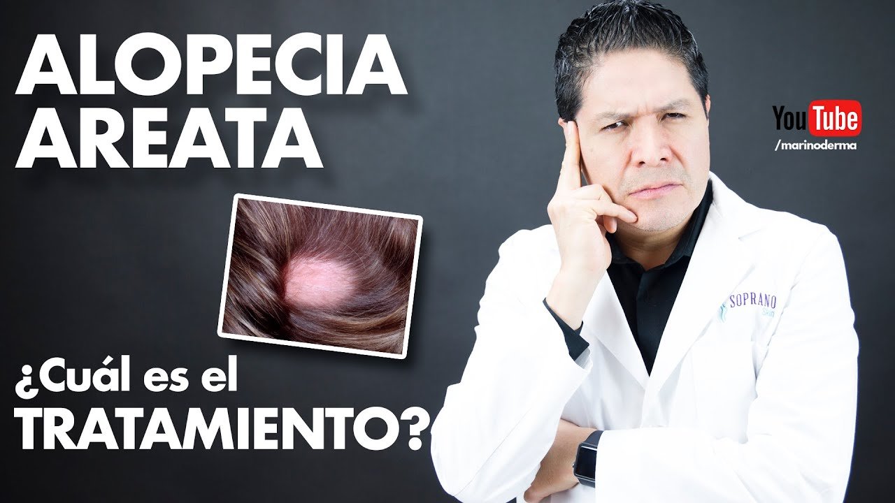 Tratamientos recomendados para la alopecia universal