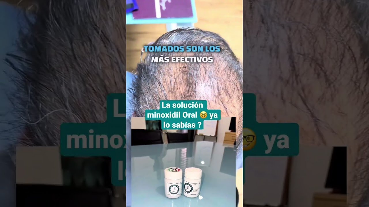 Minoxidil para calvicie hereditaria: resultados esperados
