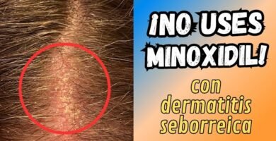 Minoxidil para cuero cabelludo sensible
