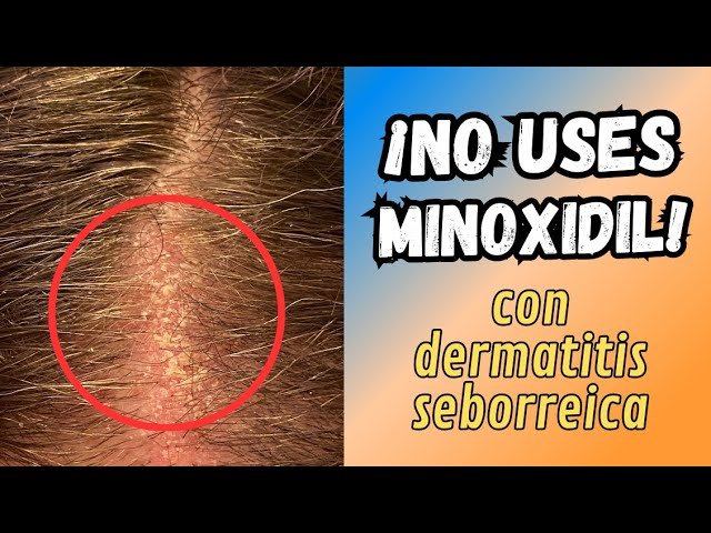 Minoxidil para cuero cabelludo sensible