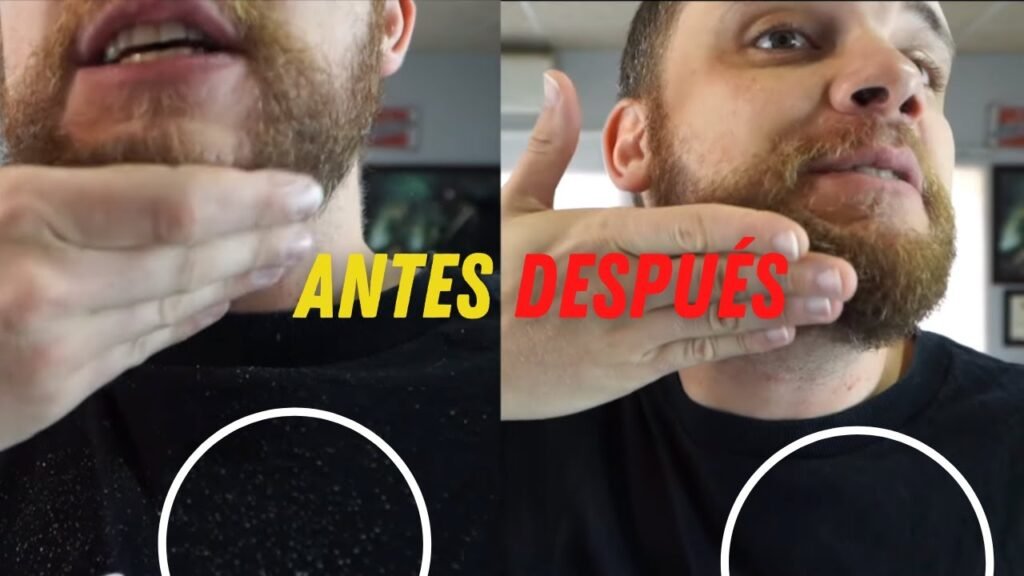 cómo evitar la caspa en la barba