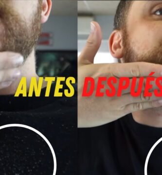 cómo evitar la caspa en la barba