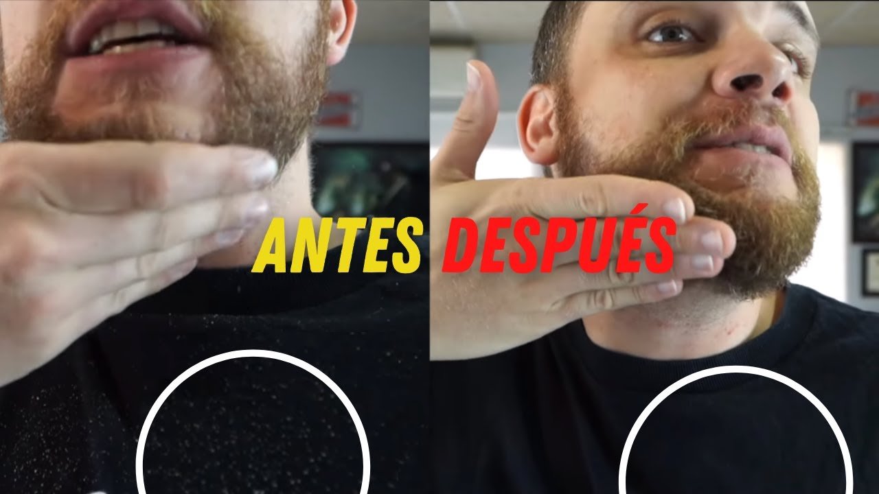 cómo evitar la caspa en la barba