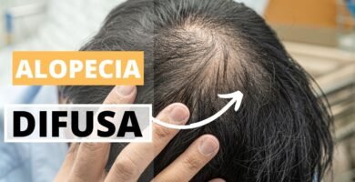 Errores comunes al tratar la alopecia difusa