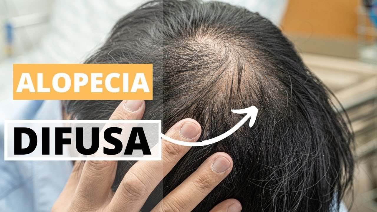 Errores comunes al tratar la alopecia difusa