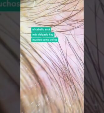 Factores genéticos que causan la alopecia total