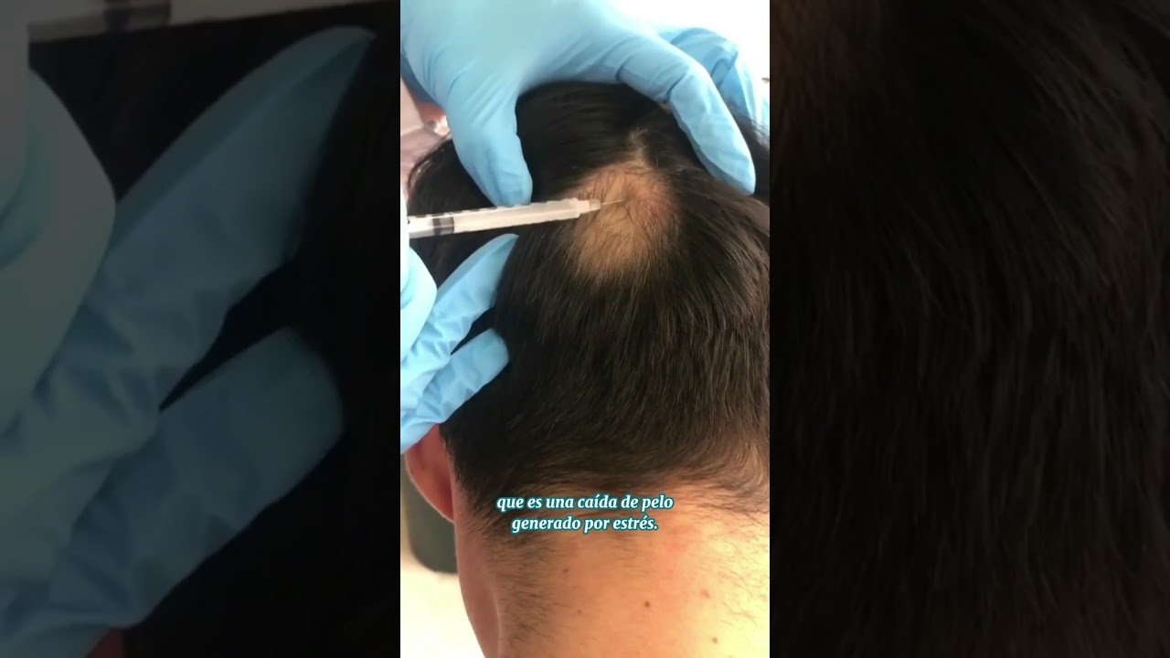 Relación entre alopecia universal y estrés