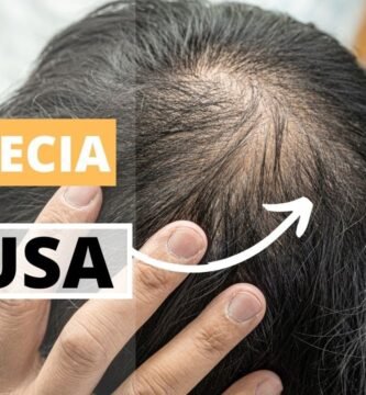 ¿Se puede revertir la alopecia difusa?