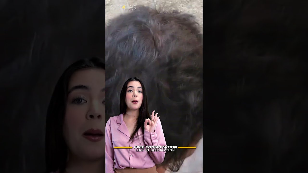 Errores comunes al tratar la minoxidil