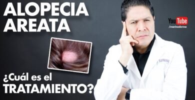 ¿Qué hacer si sufres de alopecia universal?