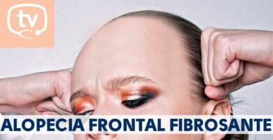 Alopecia frontal: causas y soluciones efectivas
