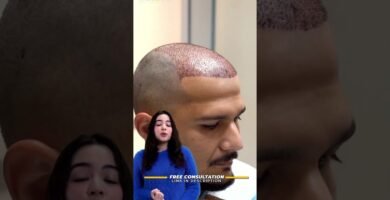 Ejercicios que ayudan con la implantes capilares