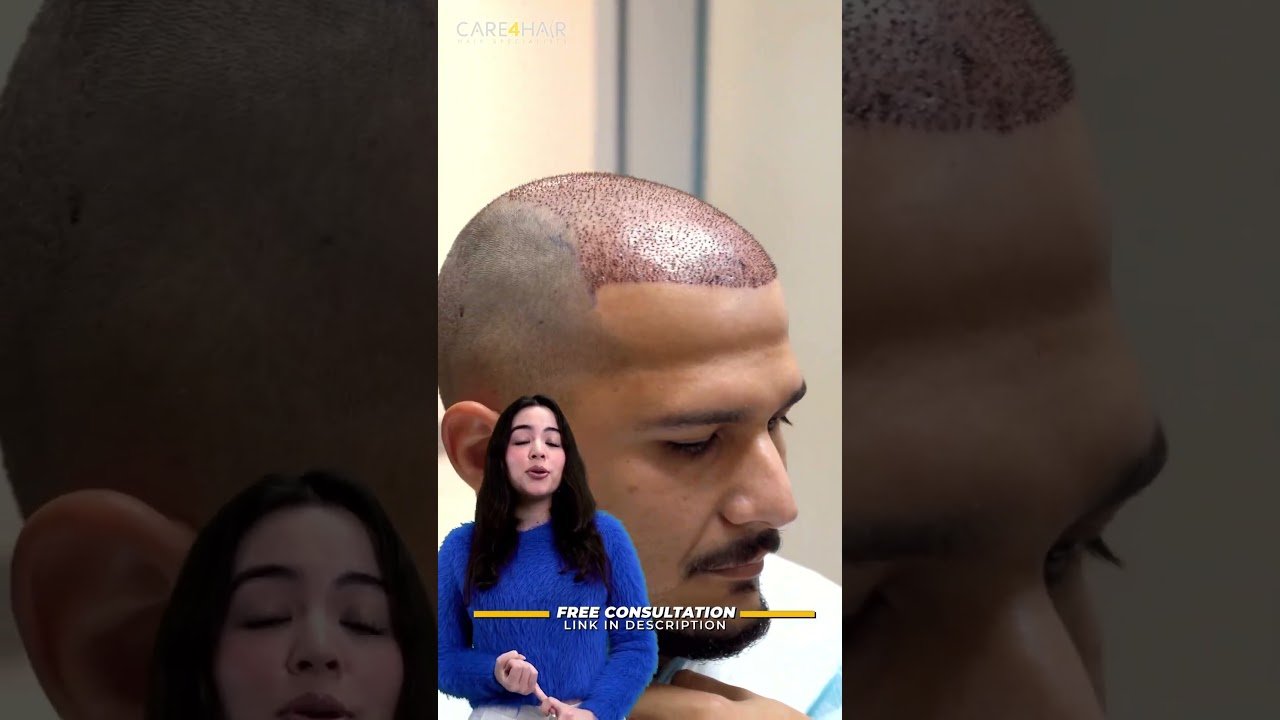 Relación entre implantes capilares y estrés