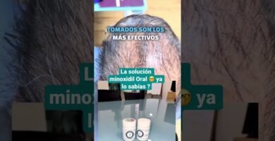 Minoxidil para alopecia androgenética: resultados precios