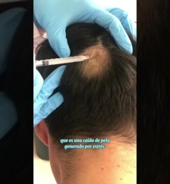Relación entre alopecia universal y el estrés