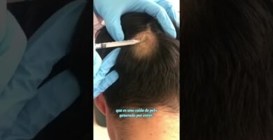 Relación entre alopecia universal y el estrés