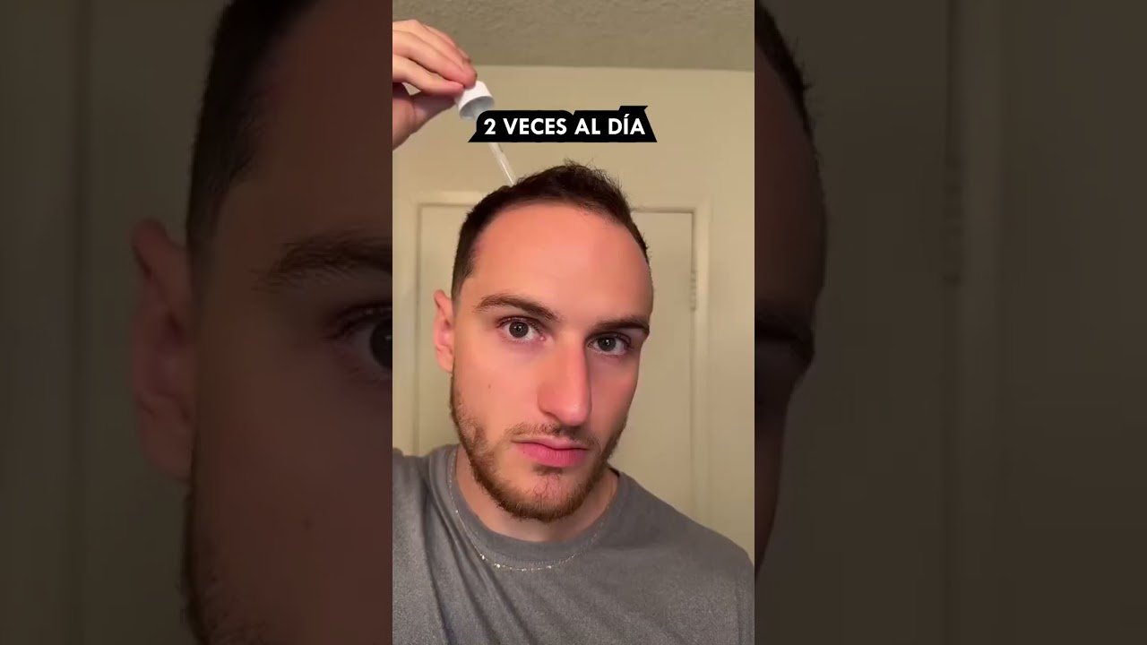 Remedios caseros para la finasteride