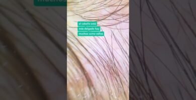 Cómo saber si tienes alopecia