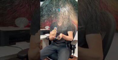 Minoxidil para calvicie femenina: efectividad efectividad comprobada