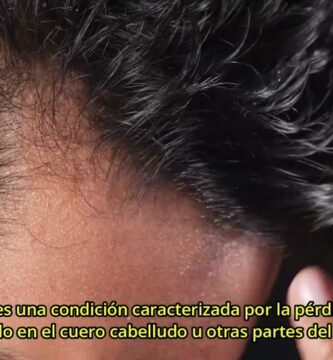 Síntomas comunes de la alopecia en hombres