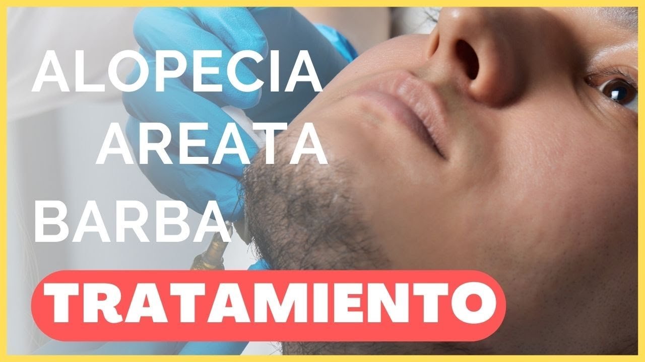 Tratamientos recomendados para la alopecia en la barba
