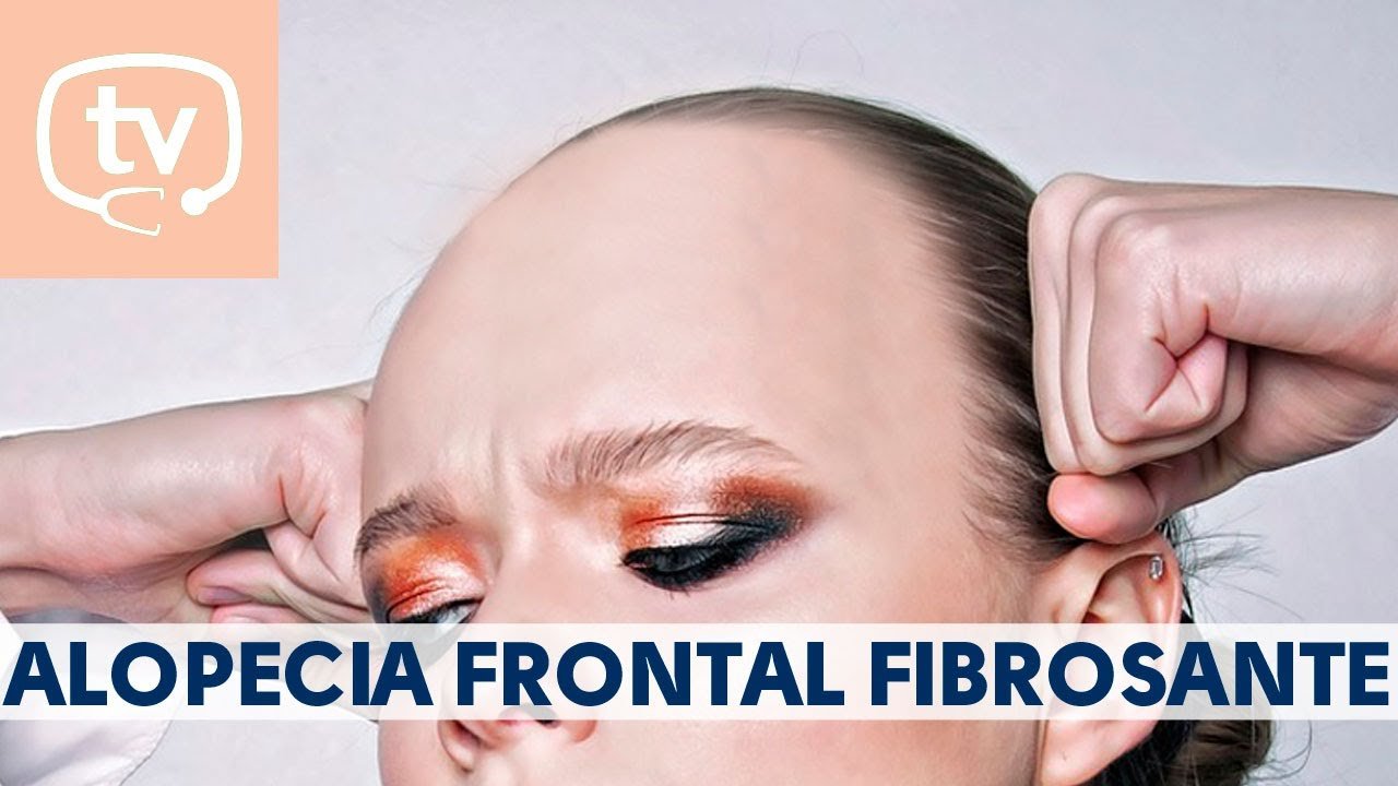 ¿Qué hacer si sufres de alopecia frontal?