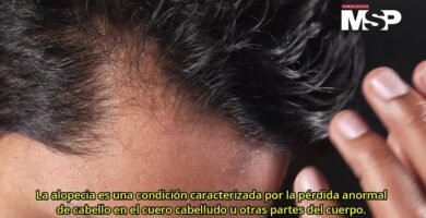 Diferencias entre alopecia areata y androgénica