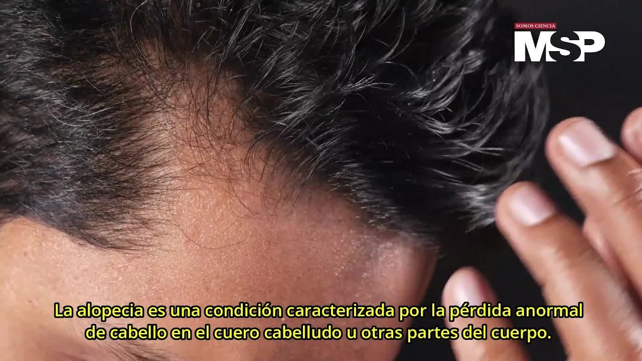 Diferencias entre alopecia areata y androgénica