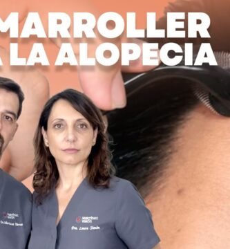 Minoxidil y dermaroller: combinación efectiva reseña