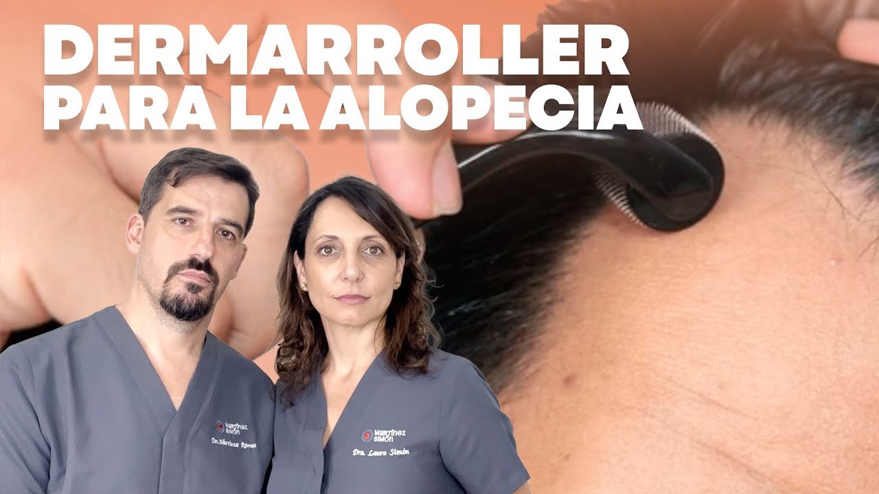 Minoxidil y dermaroller: combinación efectiva reseña