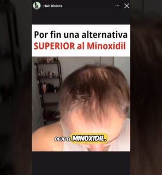 Minoxidil natural: ¿existe una alternativa? efectividad comprobada